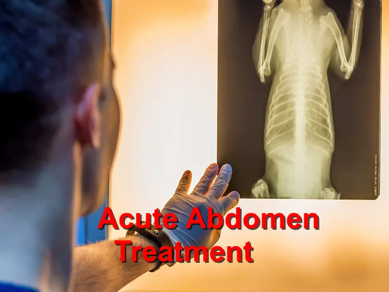 You are currently viewing Acute Abdomen Treatment